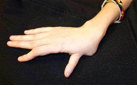 Thumb Deformity In Untreated Thumb Hypoplasia Congenital Hand And Arm