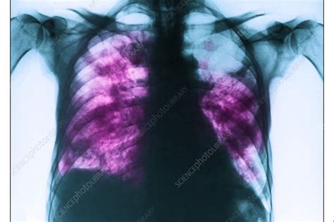 Pneumocystis Pneumonia Pcp X Ray Stock Image C0389056 Science