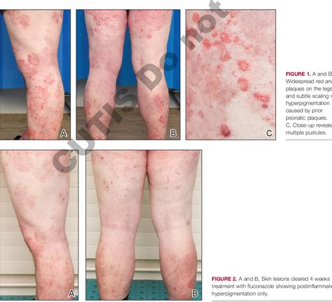 Figure 1 From Tinea Incognito Mimicking Pustular Psoriasis In A Patient