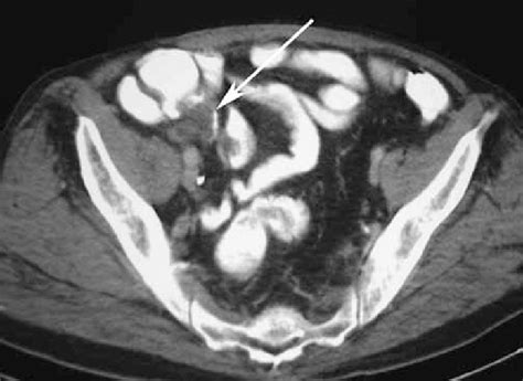 Axial Contrast Enhanced Ct Scan Demonstrates Fluidfilled Lesion