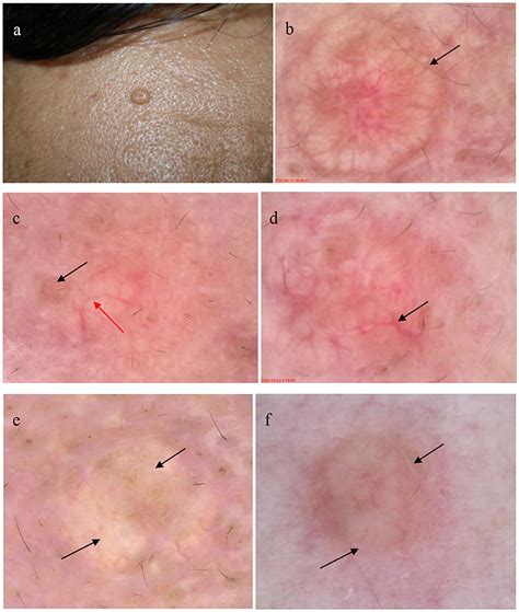Frontiers Detection Of Sebaceous Gland Hyperplasia With Dermoscopy