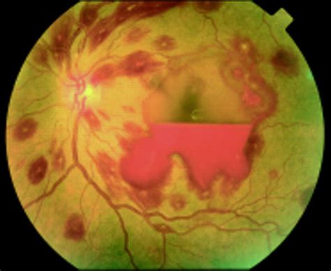 Roths Spot Causes Symptoms Treatment Roths Spot