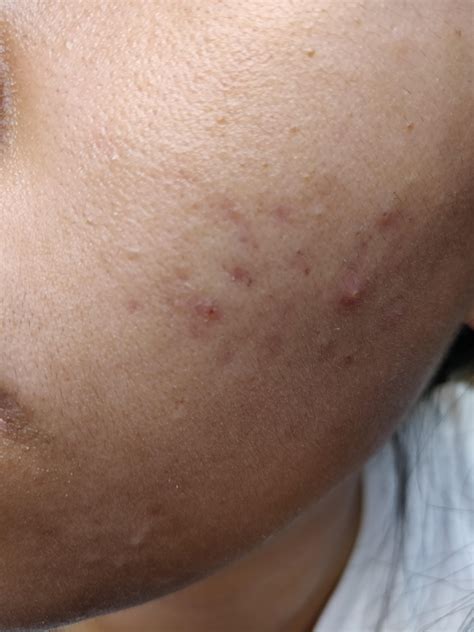 Skin Concerns Acne Scarring Is Not Inproving 6 Months R