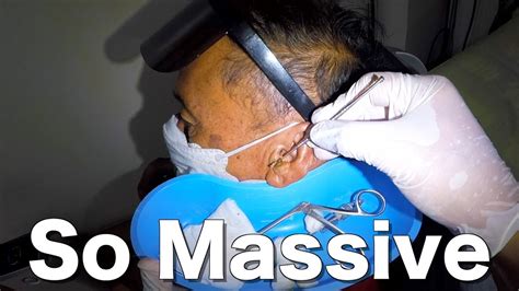 Massive Earwax Removed From Mans Ear Youtube