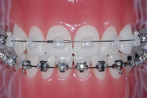 Types Of Braces Mko Mark Kum Orthodontist