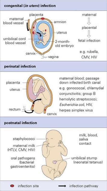 Obstetric And Perinatal Infections Clinical Manifestation And