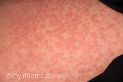 Allergic Reaction Rash To Penicillin Antibiotic Allergic Reaction