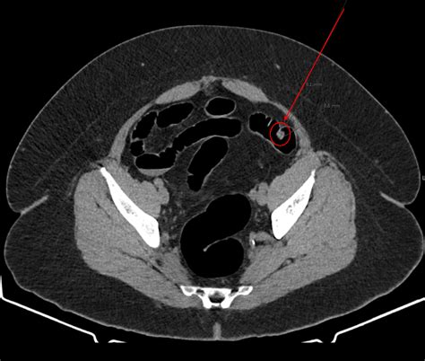 Colorectal Cancer Screening Options University Diagnostic Medical Imaging