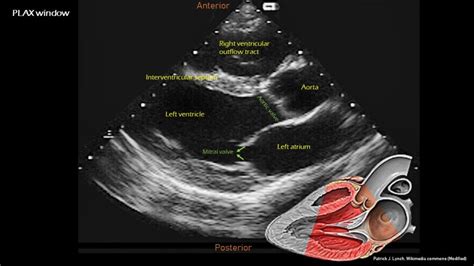 Introduction To Focused Cardiac Ultrasound The Parasternal Long Axis