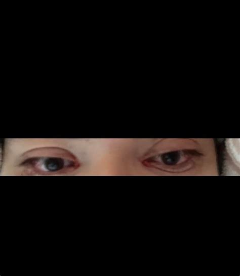 did you experience post surgery double vision r strabismus