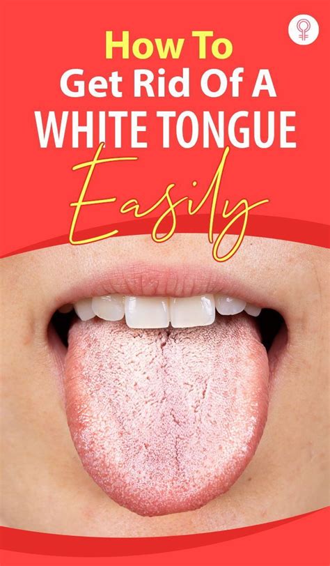 14 Home Remedies For White Tongue And Prevention Tips Artofit