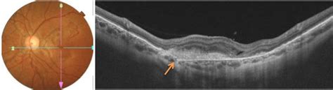 Figure Optical Coherence Tomography Shows The Angioid Streaks As