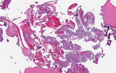 Pathology Outlines Who Classification