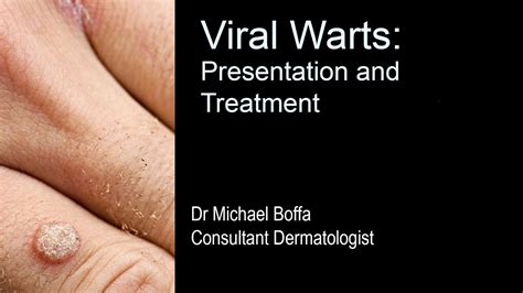 Viral Warts Presentation And Treatment Youtube