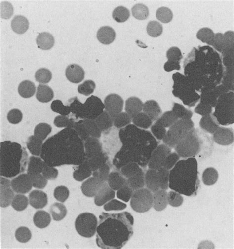 Atypical Lymphocytes In Acute Infectious Mononucleosis — Identification