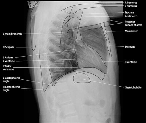 Anatomy of the chest and the lungs: Normal Chest X-Ray • LITFL Medical Blog • Labelled Radiology