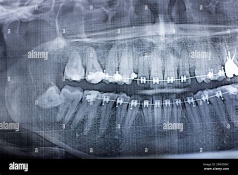 X Ray Photograph Of Human Teeth With A Braces System Retarded Wisdom