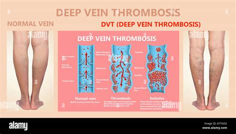 Deep Vein Thrombosis Or Blood Clots Embolus Stock Photo Alamy