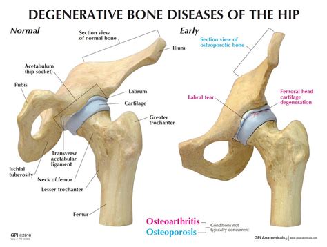 Gpi 1320 4 Stage Degenerative Bone Diseases Of The Hip Model