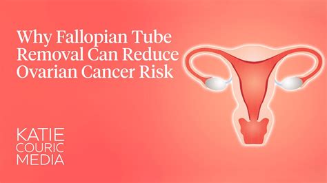 Why Fallopian Tube Removal Can Reduce Cancer Risk Youtube