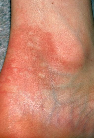 Itchy Bumps On Ankles Core Plastic Surgery