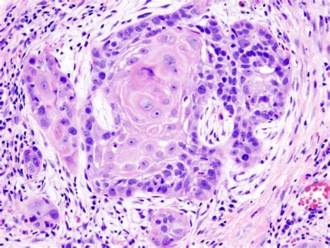 Other histologies such as squamous, adenosquamous, carcinoid tumors, or lymphoid tumors are occasionally identified. Head and neck squamous-cell carcinoma - Wikipedia