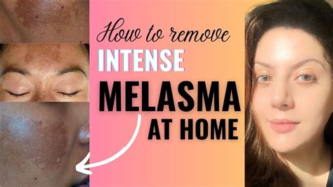How To Remove Melasma From Face Permanently At Home I Melasma Removal
