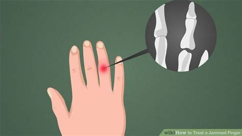 How To Treat A Jammed Finger 8 Steps With Pictures Jammed Finger