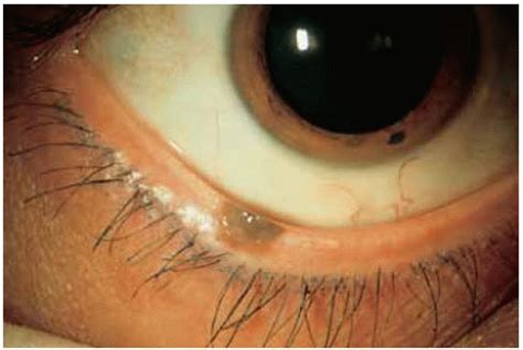 Melanoma Eyelid