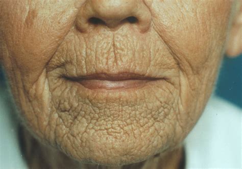 Ednas Anti Aging Site Smoking Vs Wrinkles