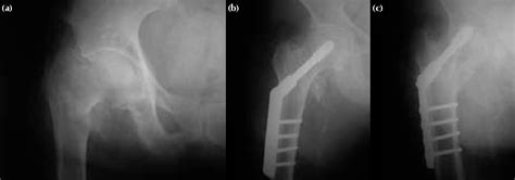 Figure 1 From Subcapital Femoral Neck Fracture Following Successful