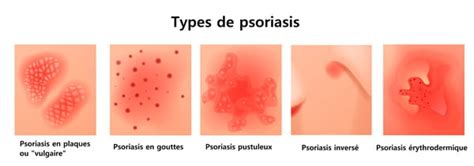 Psoriasis Symptômes Types Causes Et Traitement Page 3 Sur 7