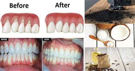 These 10 Natural Remedies Will Help Grow Back Your Receding Gums In No
