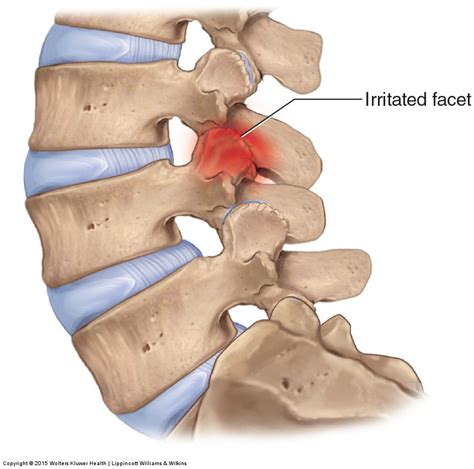 Facet Syndrome And Lower Back Pain Dr Karen Hudes At Continuum Wellness