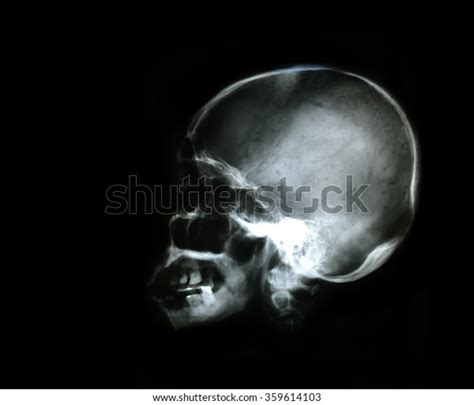 Xray Skull Blank Area Left Side Stock Photo 359614103 Shutterstock