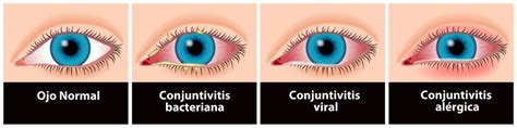 Conjuntivitis The Best Porn Website