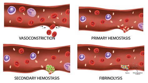 Hemostasis Keeping Our Blood Where It Belongs My Hematology