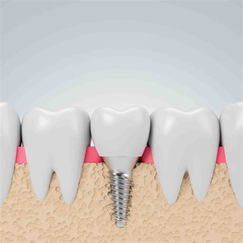 What Are Dental Implant Crowns Made Of Dental News Network