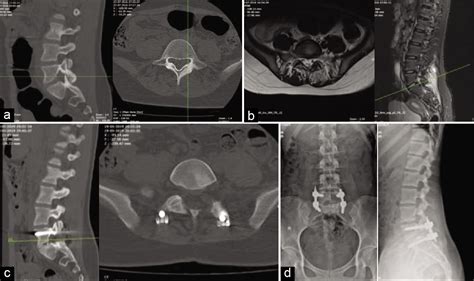 Spinal Osteoid Osteoma Surgical Resection And Review Of Literature