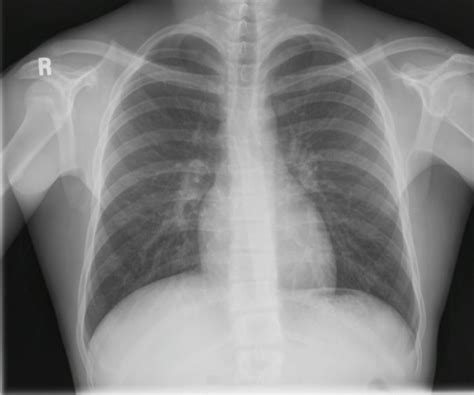 Neat How To Report Normal Chest X Ray Write A Good Introduction For