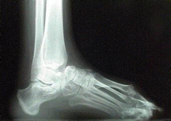 However, in these cases, the foot is usually more deformed. Clubfoot (congenital talipes equinovarus) - Pediatrics ...