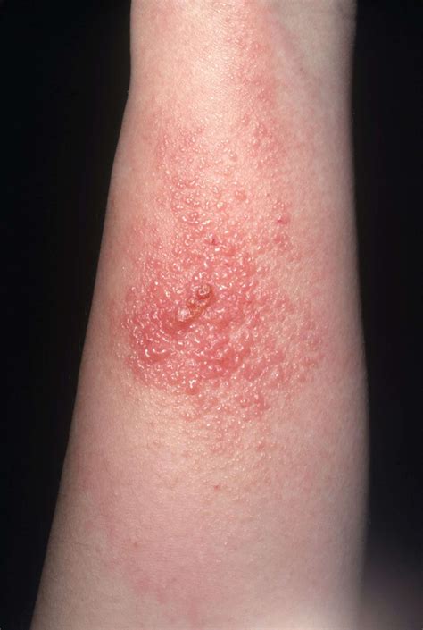 What Does Poison Ivy Rash Look Like Austra Health