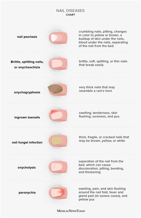 Nail Diseases Chart Pictures Symptoms And Treatments