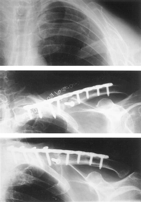 Figure 1 From Surgical Treatment Of Post Radiotherapy Nonunions Of The