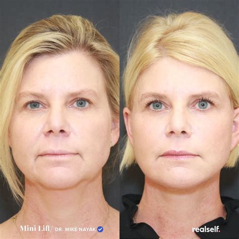 What Is A Mini Facelift Mini Face Lift Botox Face Facelift Procedure