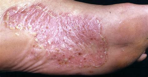 Psoriasis Skin Disease Causes Symptoms And Treatments Premier Clinic