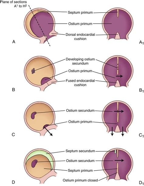 Atrial Septal Defect Anatomy