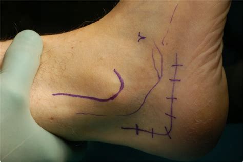 Skin Marking Of The Lateral Malleolus Sural Nerve And Extensile