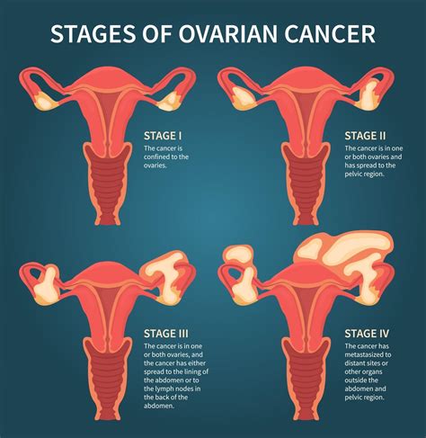 Stages Of Womans Ovarian Cancer Dark Blue Scheme 3238421 Vector Art At