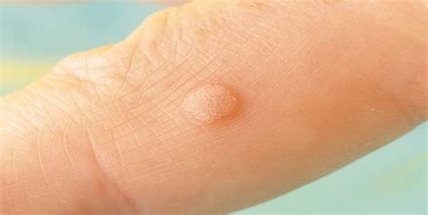 7 Magical Ways To Kiss The Warts Away At Home Natural Ways To Remove